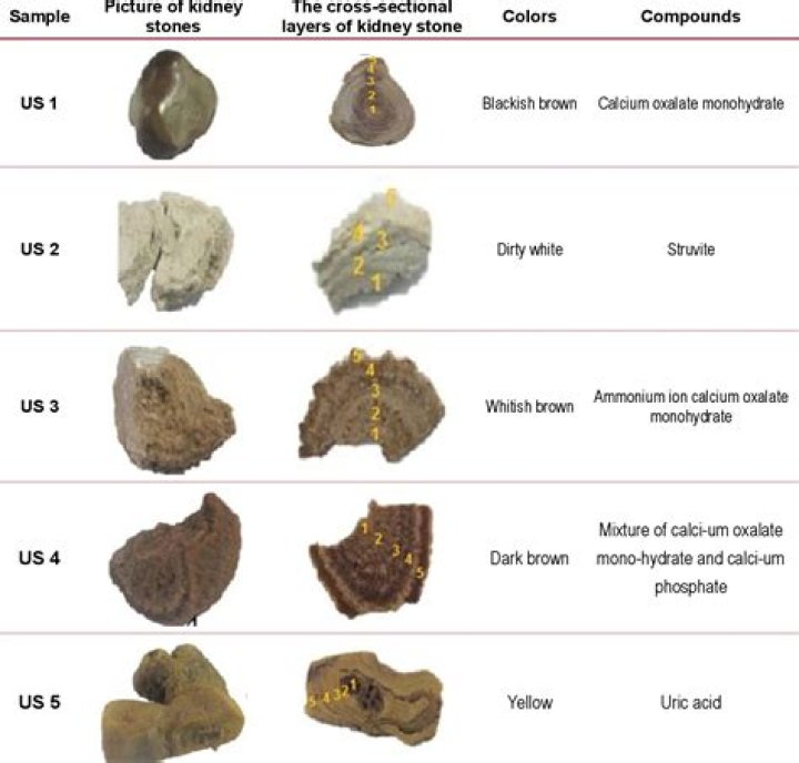 Are kidney stones black?