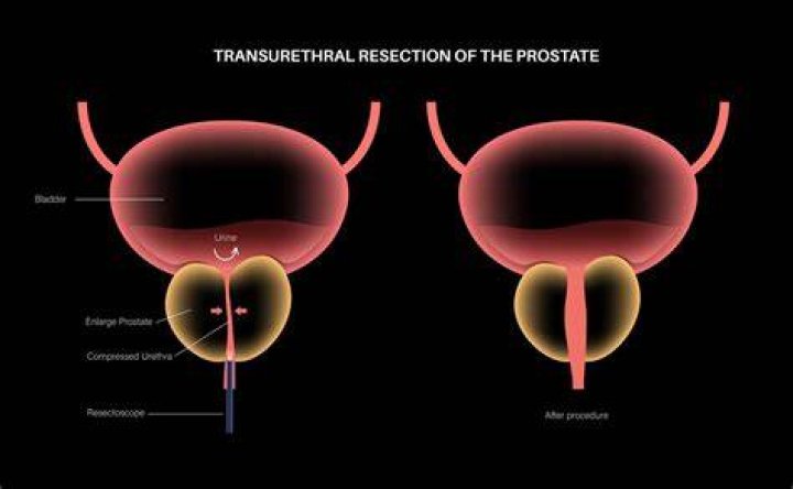 Are you impotent after prostate surgery?