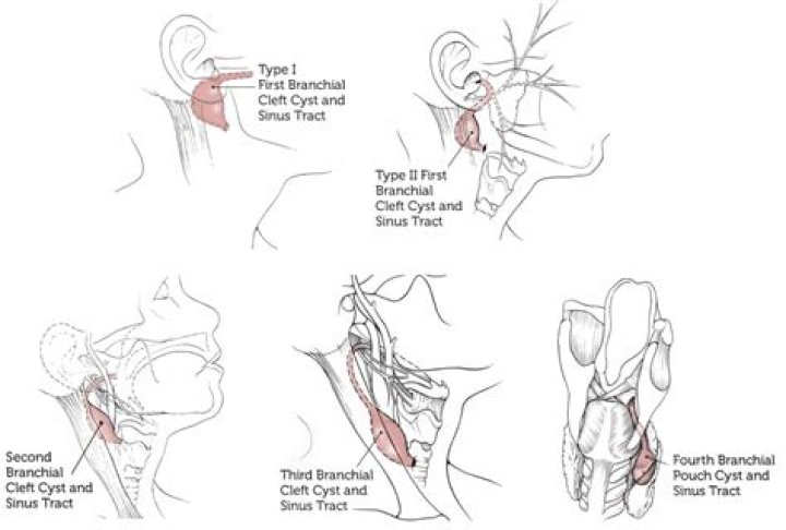 Do branchial cysts have to be removed?