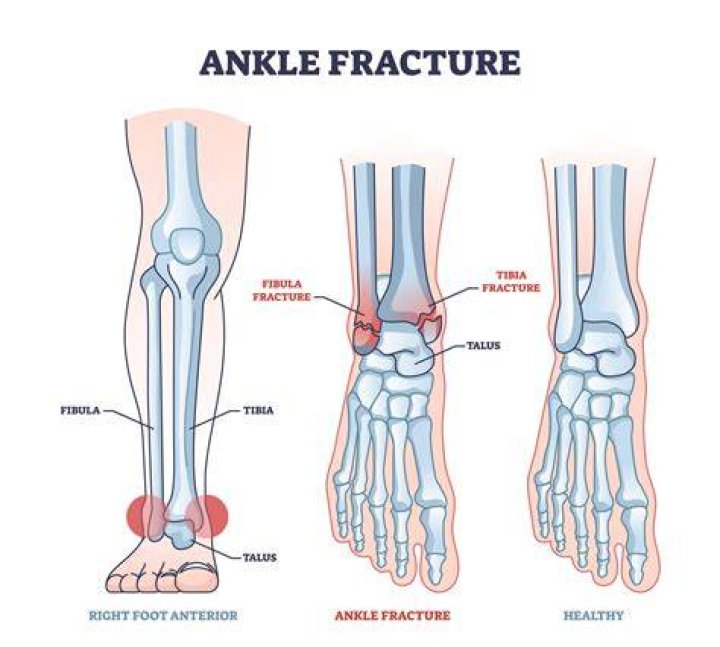 Does ice help a fractured foot?