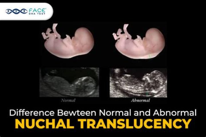 Is 1.2 mm nuchal translucency good?