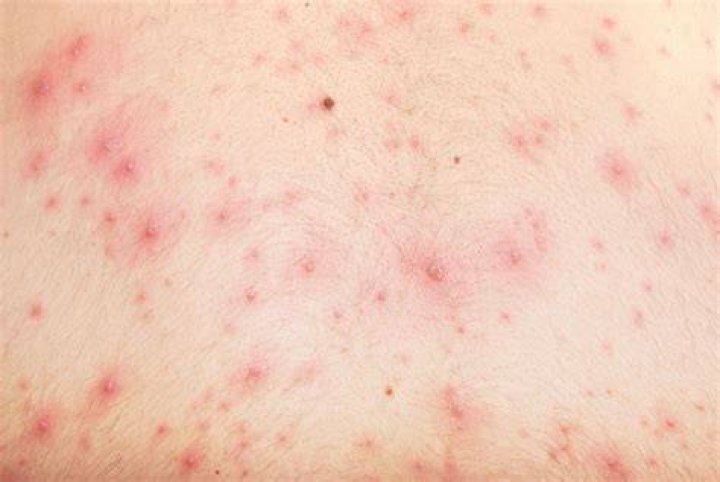 Is chickenpox still around?