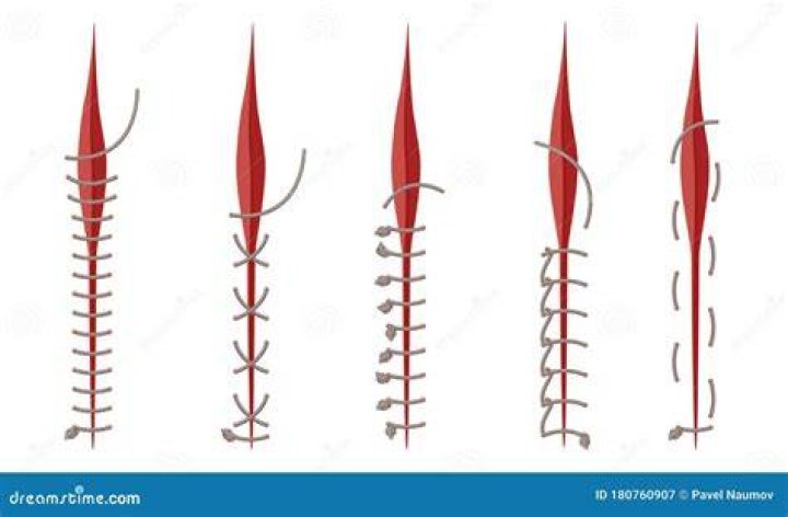 Is stitches considered surgery?