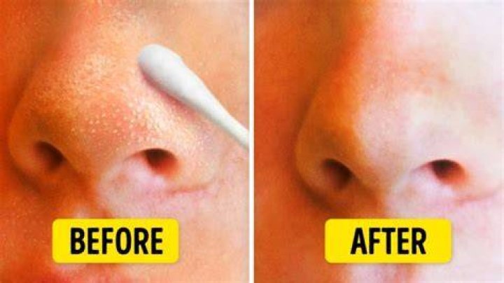 Should you extract blackheads?