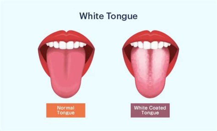 What causes a thick white coated tongue?