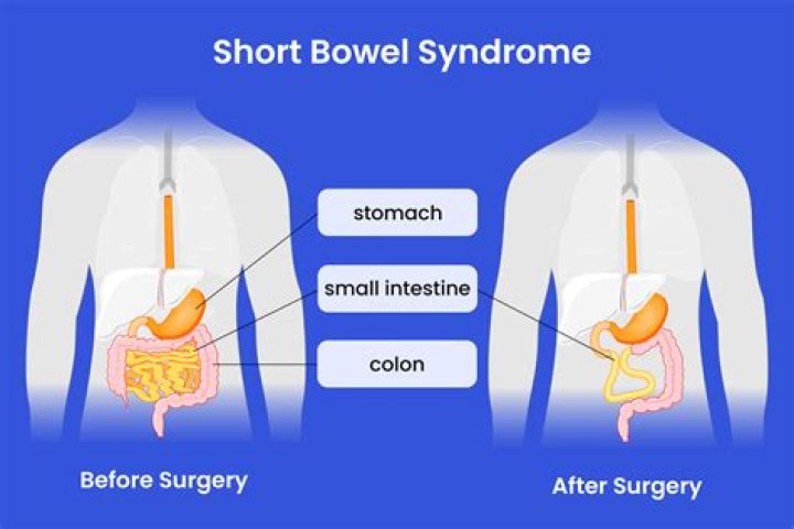 What is short bowel syndrome?