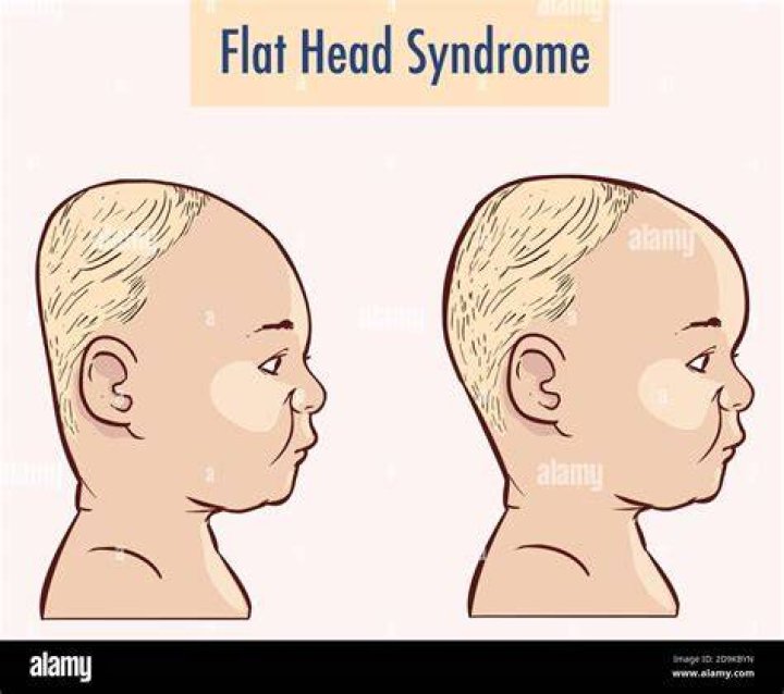 Whats flat head syndrome?