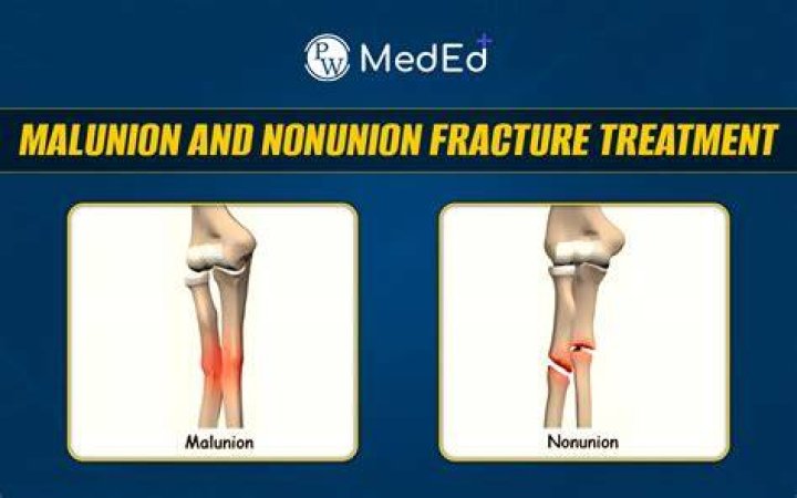 When is a fracture considered nonunion?