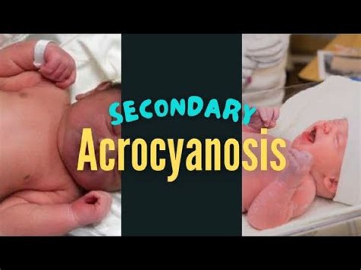 Why does acrocyanosis occur in newborns?