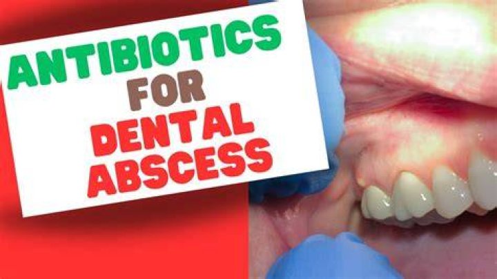 Will an abscess go away with antibiotics?
