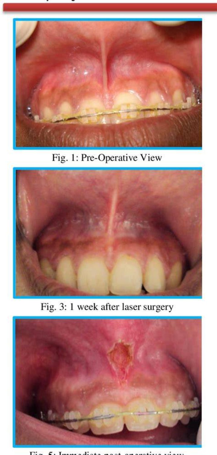 Will labial frenulum grow back?